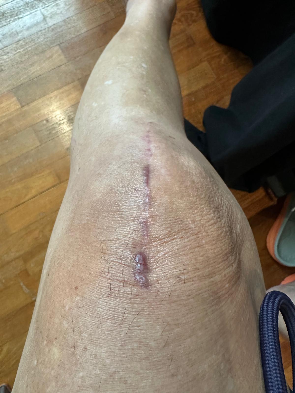 The same knee later in recovery, the surgical scar healed and flat.