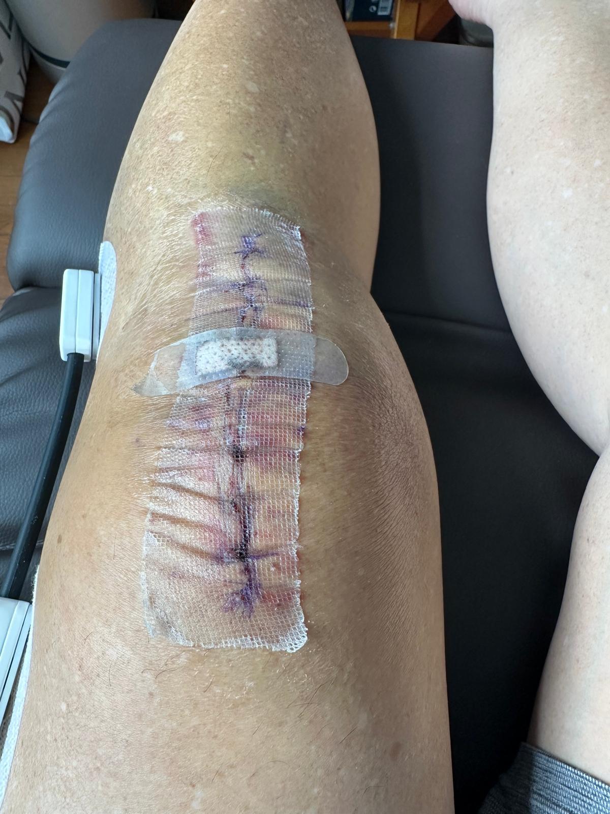 A knee shortly after surgery, the incision still covered by a mesh dressing.